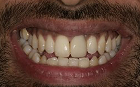 Before and After