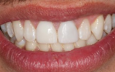 Before and After