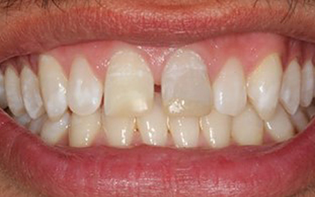 Before and After