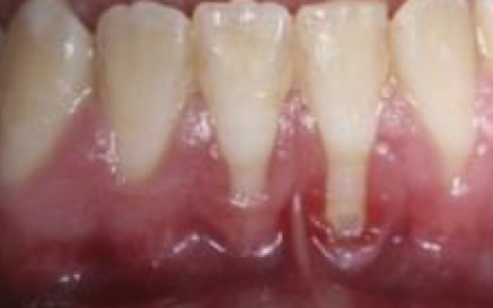 Before and After