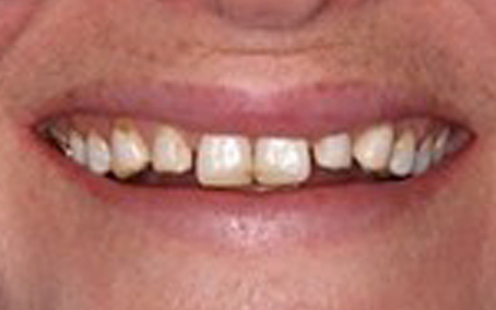 Before and After